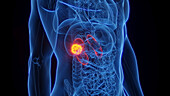 Kidney cancer, illustration