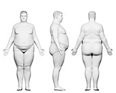 Obese male body, illustration