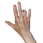 Dupuytren's contracture, illustration