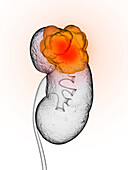 Kidney cancer, illustration