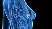 Breast cancer, illustration