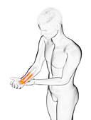 Man with a painful wrist, illustration