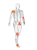 Walker's painful joints, illustration