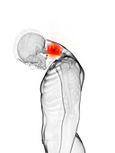 Man's painful neck, illustration