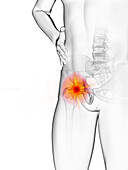 Man with a painful hip joint, illustration