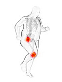 Obese runner's painful joints, illustration