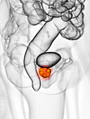 Prostate cancer, illustration