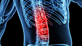 Painful lumbar spine, illustration