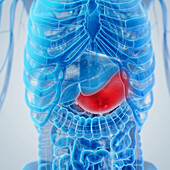 Inflamed stomach, illustration