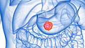 Stomach tumour, illustration
