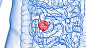 Intestine tumour, illustration