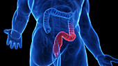 Ulcerative colitis, illustration