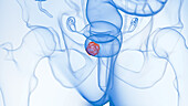 Bladder tumour, illustration