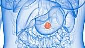 Stomach tumour, illustration