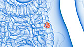 Colon tumour, illustration