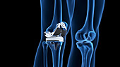 Knee replacement, illustration