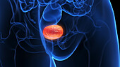 Inflamed bladder, illustration