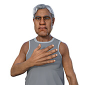 Man with acromegaly, illustration