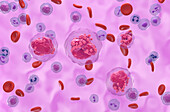 Acute lymphoblastic leukemia, illustration