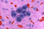 Acute myeloid leukemia, illustration