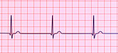 Junctional rhythm of the heartbeat, illustration