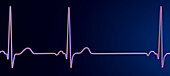 Sinus arrhythmia heartbeat rhythm, illustration