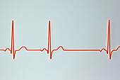 Sinus arrhythmia heartbeat rhythm, illustration