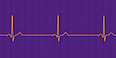 Sinus bradycardia heartbeat rhythm, illustration