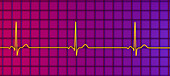 Sinus bradycardia heartbeat rhythm, illustration