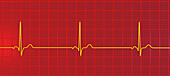 Sinus bradycardia heartbeat rhythm, illustration