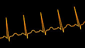 Sinus tachycardia heartbeat rhythm, illustration