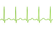 Sinus tachycardia heartbeat rhythm, illustration