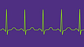 Sinus tachycardia heartbeat rhythm, illustration