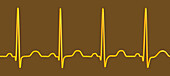 Sinus tachycardia heartbeat rhythm, illustration