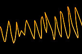 Torsades de pointes heartbeat rhythm, illustration