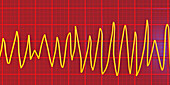 Torsades de pointes heartbeat rhythm, illustration