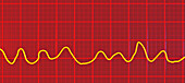 Ventricular fibrillation heartbeat rhythm, illustration