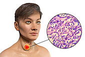 Woman with thyroid cancer, illustration