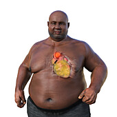 Obese man with ascending aortic aneurysm, illustration