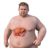 Overweight man with liver steatosis, illustration