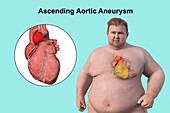 Obese man with ascending aortic aneurysm, illustration