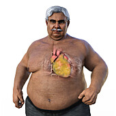 Overweight man with enlarged heart, illustration