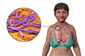 Lungs affected by apical tuberculosis, illustration