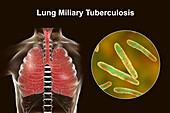 Lungs affected by miliary tuberculosis, illustration