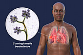 Lung mucormycosis lesion, illustration