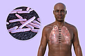 Apical tuberculosis, illustration