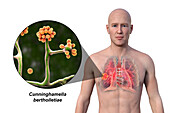 Lung mucormycosis lesion, illustration