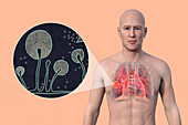 Lung mucormycosis lesion, illustration