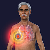 Lungs affected by lung cancer, illustration