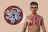 Lungs affected by cavernous tuberculosis, illustration